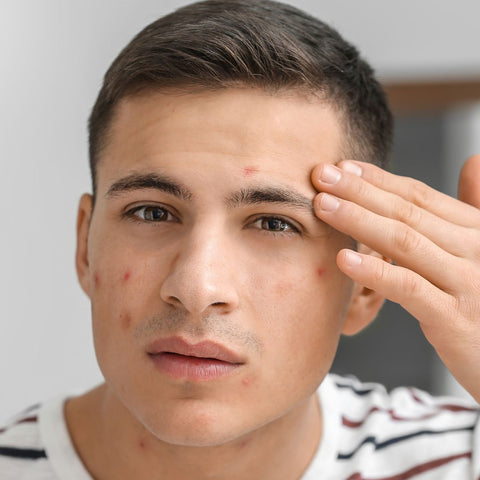 Skincare Przeciw Trądzikowi